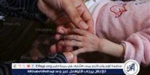 الطفلة ملك تثير القلق الطبي والإنساني.. دماغ مفقود وسط واقع حرب الإبادة في غزة