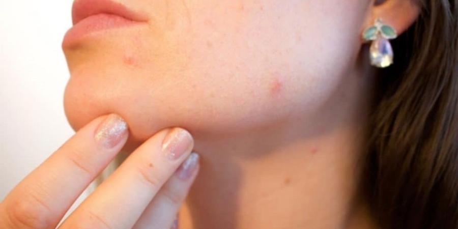 الإصابة بحب الشباب تزيد مخاطر التعرض للاضطرابات الغذائية