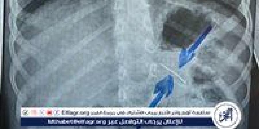 قسم الجراحة..ينجح فى استخراج دبوس من معدة صغير بسوهاج